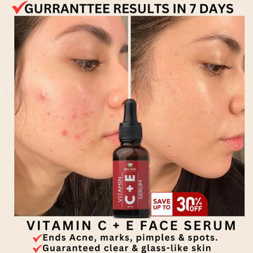 ANTI ACNE & GLOWING SERUM VITAMIN C + E